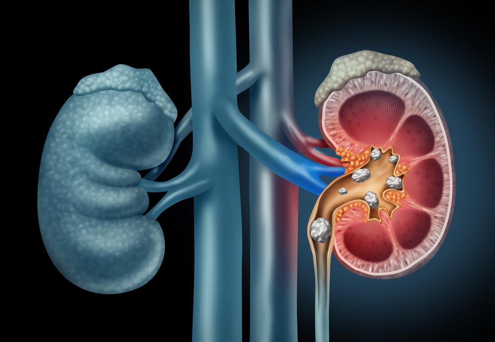 Kidney Stone Treatment in Hadapsar, Pune