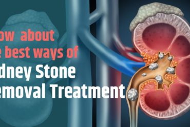 Kidney Stone Removal Treatment