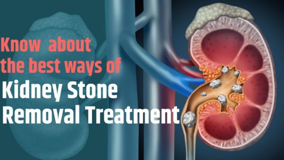 Kidney Stone Removal Treatment